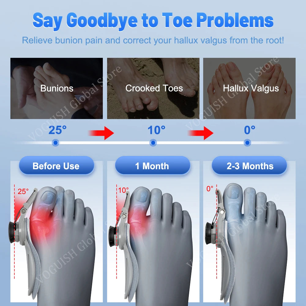 Unisex Bunion Corrector Splint: Big Toe Straightener for Hallux Valgus Relief - Orthopaedic Foot Care and Pain Alleviation